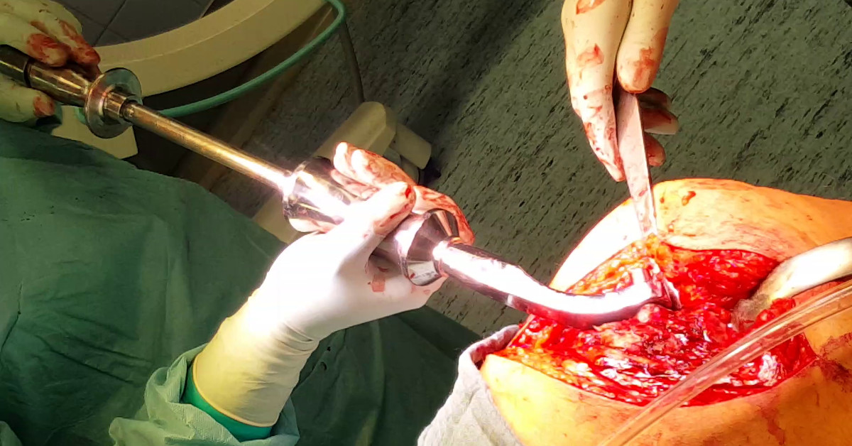 EndoDriver in OP